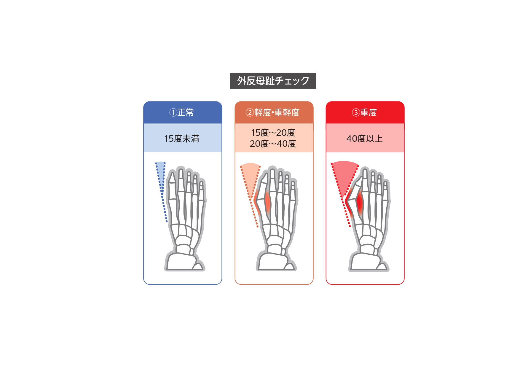 外反母趾の症状の程度別対策と改善方法を紹介 軽度 重度 Tential テンシャル 公式オンラインストア