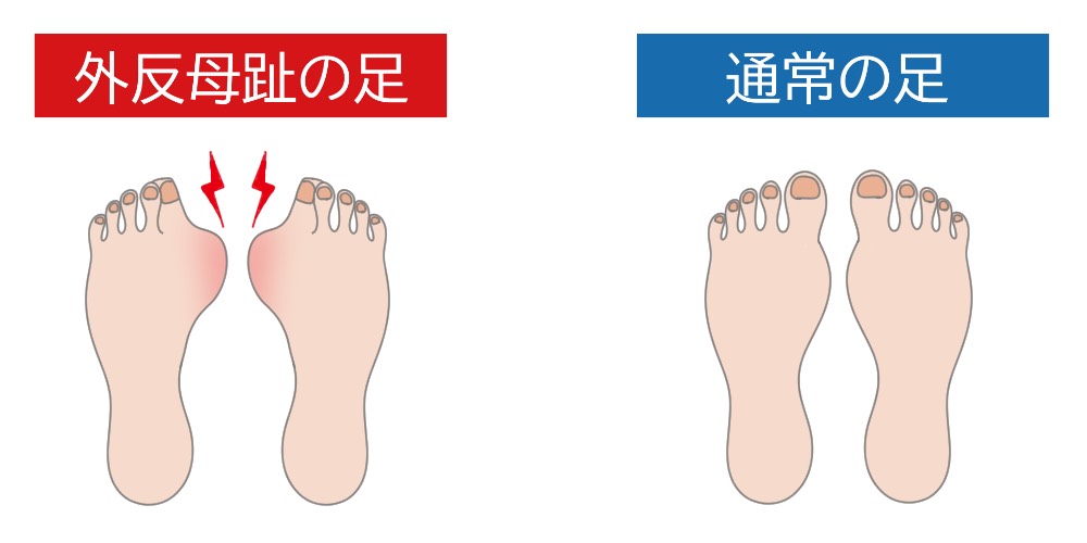 インソールは外反母趾に効果があるのか インソールの選び方を紹介 Tential テンシャル 公式オンラインストア