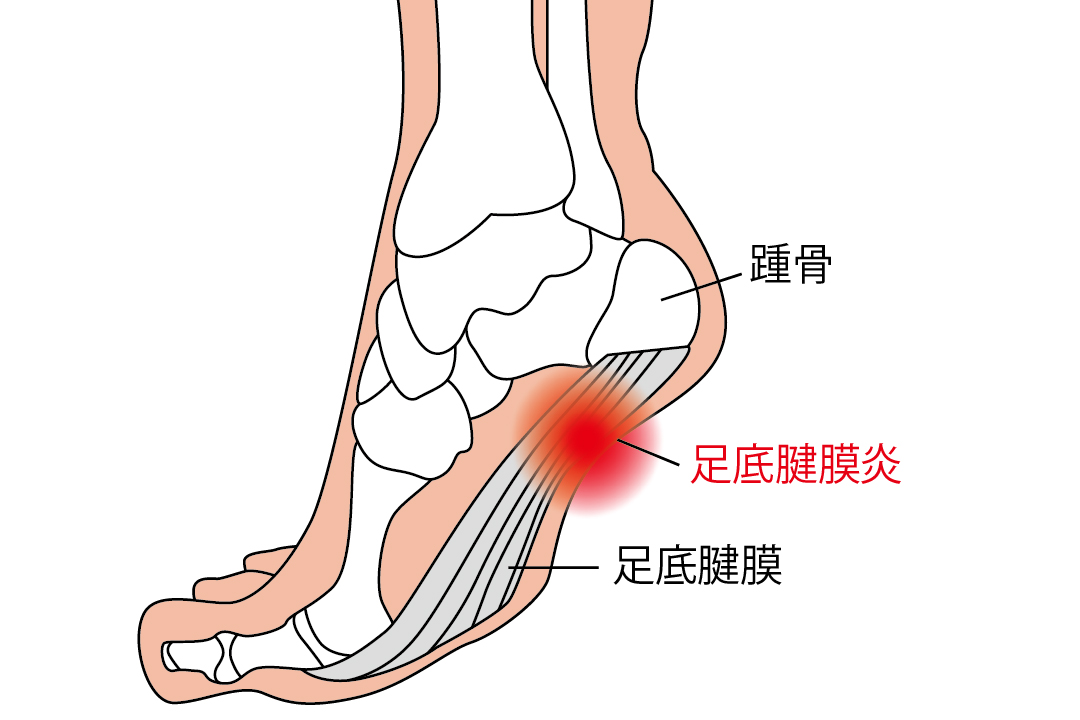 足底筋膜炎のストレッチ方法について解説 予防と痛みの緩和に効果的 Tential テンシャル 公式オンラインストア