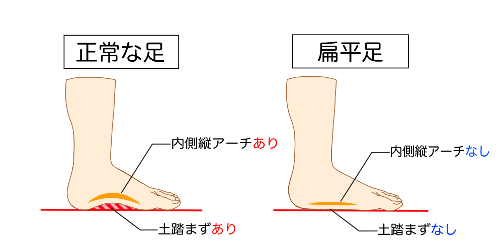 インソールは扁平足に効果があるのか インソールの選び方を紹介 Tential テンシャル 公式オンラインストア