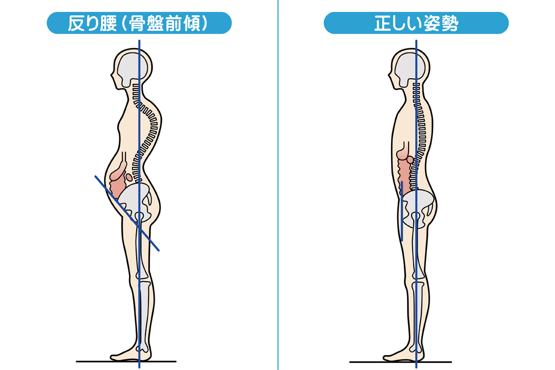 骨盤の歪みが腰痛の原因に ぽっこりお腹の原因 反り腰 についても解説 Tential テンシャル 公式オンラインストア