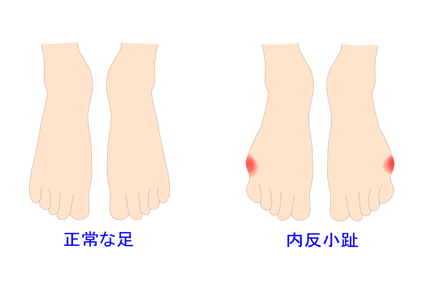内反小趾の治療について 内反小趾にならない歩き方も紹介 Tential テンシャル 公式オンラインストア