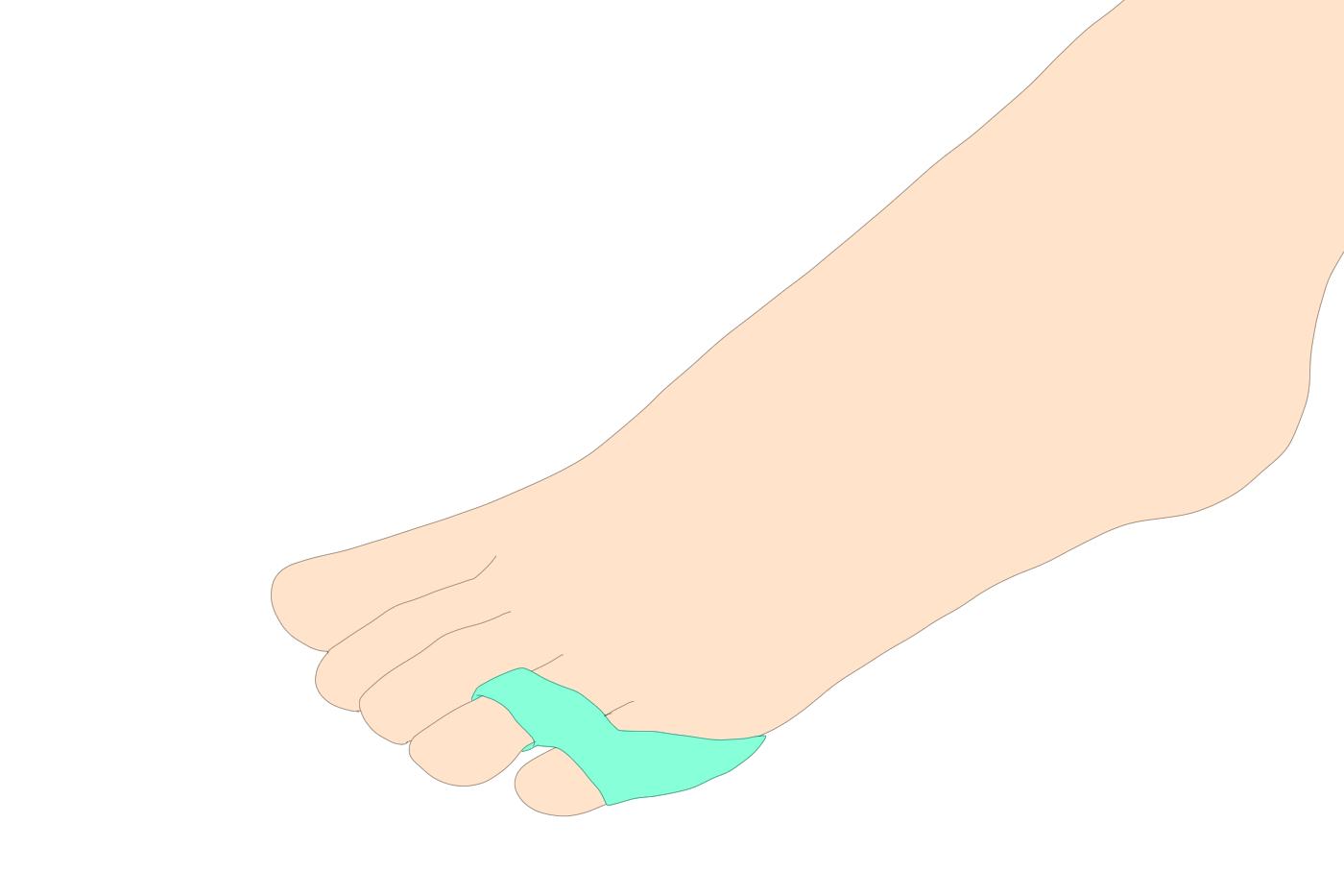 内反小趾の治療について 内反小趾にならない歩き方も紹介 Tential テンシャル 公式オンラインストア
