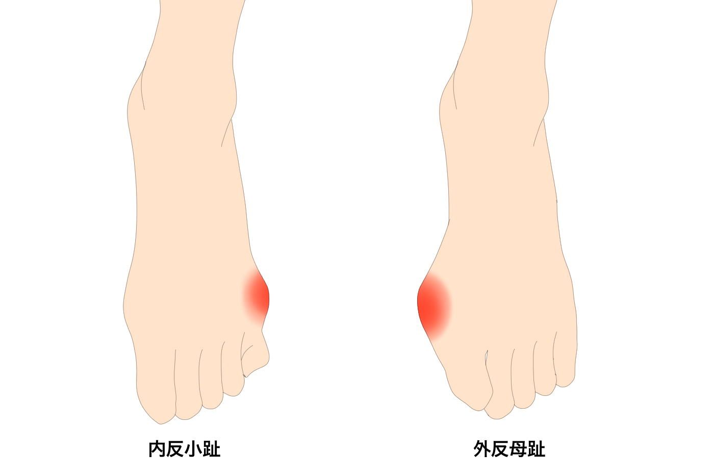 内反小趾の原因とは 外反母趾との違いや靴の重要性も解説 Tential テンシャル 公式オンラインストア