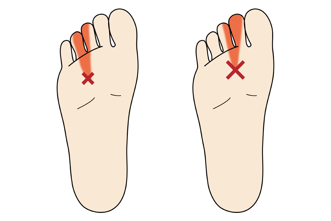 モートン病対策にはインソール 効果や選び方ぼポイントを徹底解説 Tential テンシャル 公式オンラインストア