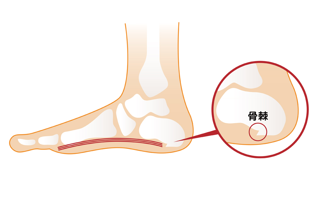 踵骨棘とは ケア ストレッチ方法を解説 インソールについても紹介 Tential テンシャル 公式オンラインストア