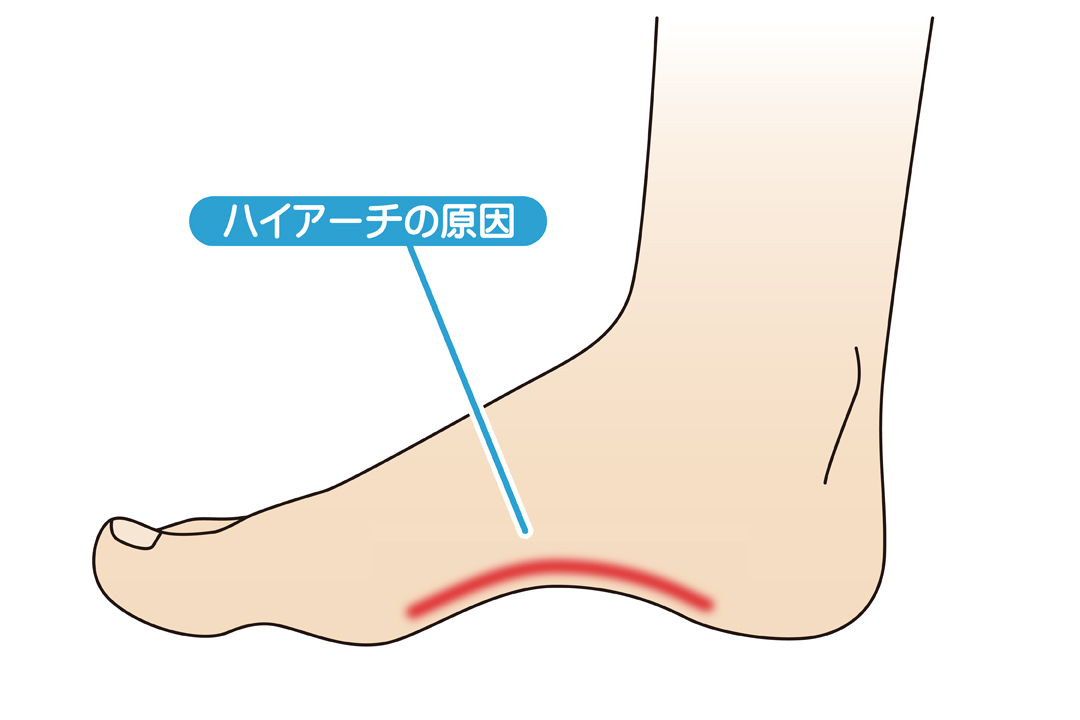 足のハイアーチになる原因と改善に役立つ3種類の方法を紹介 Tential テンシャル 公式オンラインストア