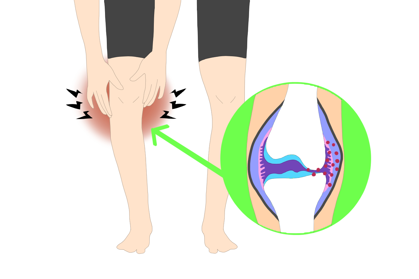 膝の痛み 膝に水が溜まるって何 具体的な状態や癖になるかどうかについて解説 Tential テンシャル 公式オンラインストア